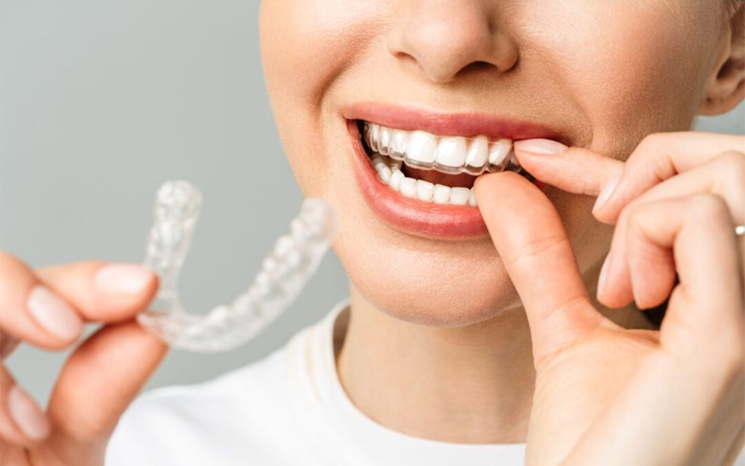 Everything you need to know about Invisalign Aligners –  The Invisible Braces…!