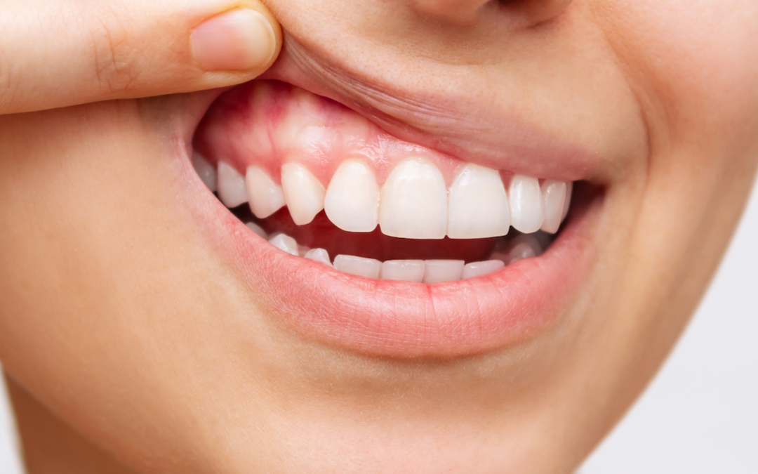 Smile Bright: Toothway Dental’s Guide to Oral Care During Braces Treatment