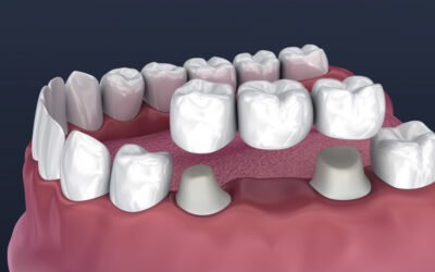 Essential Post-Operative Care Tips After Dental Crown and Bridge Placement