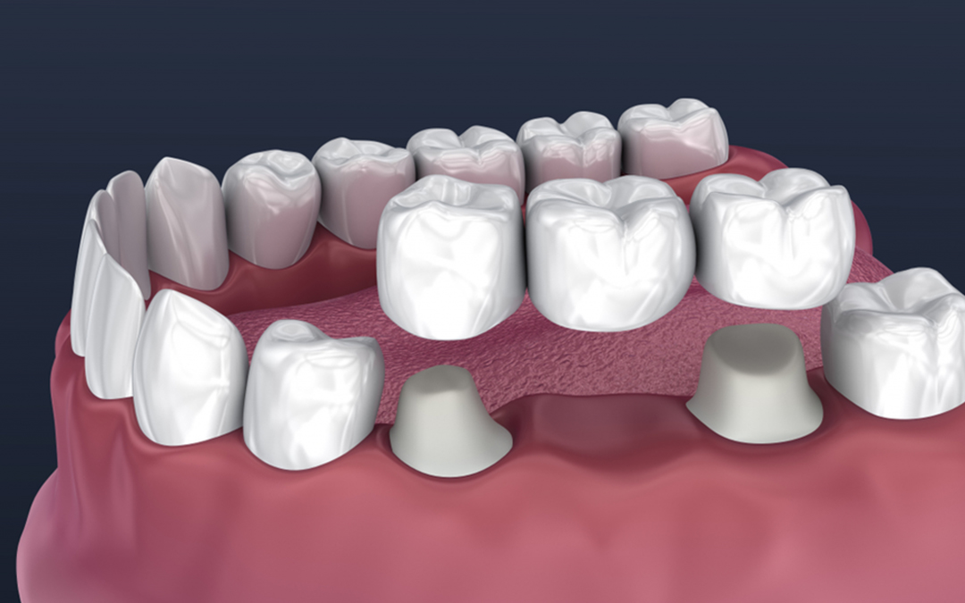 Essential Post-Operative Care Tips After Dental Crown and Bridge Placement