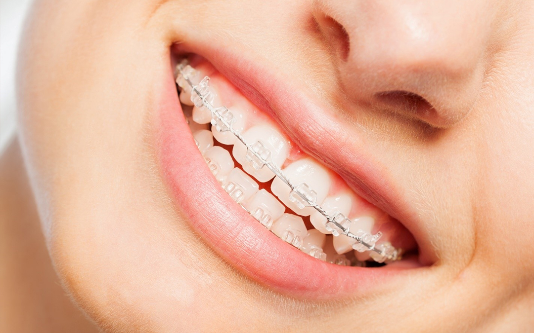 Self-Ligating Braces vs. Traditional Braces: A Comprehensive Guide