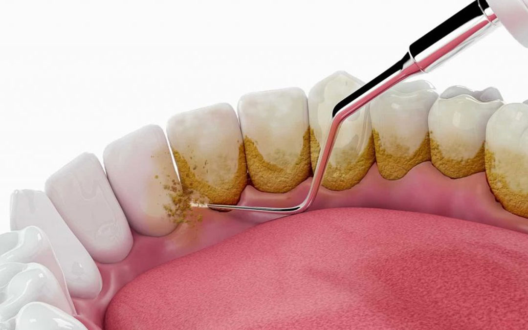 Does Regular Scaling or cleaning of Teeth damage the Tooth Enamel?