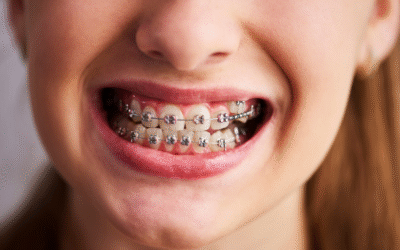 Traveling with braces – how to maintain cleanliness