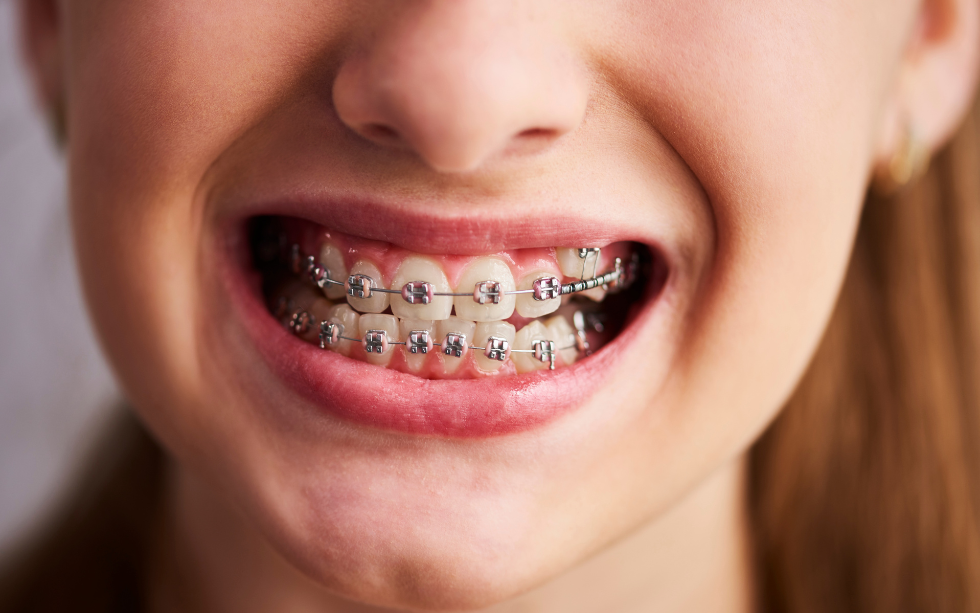 Traveling with braces – how to maintain cleanliness