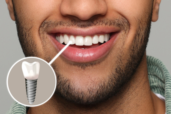 Oral Care Post Implant Placement
