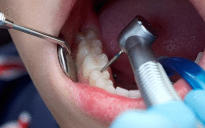 Oral Care Post Fillings/Restoration