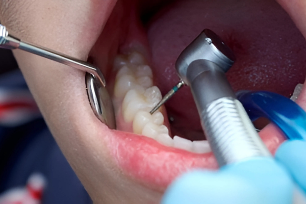 Oral Care Post Fillings/Restoration