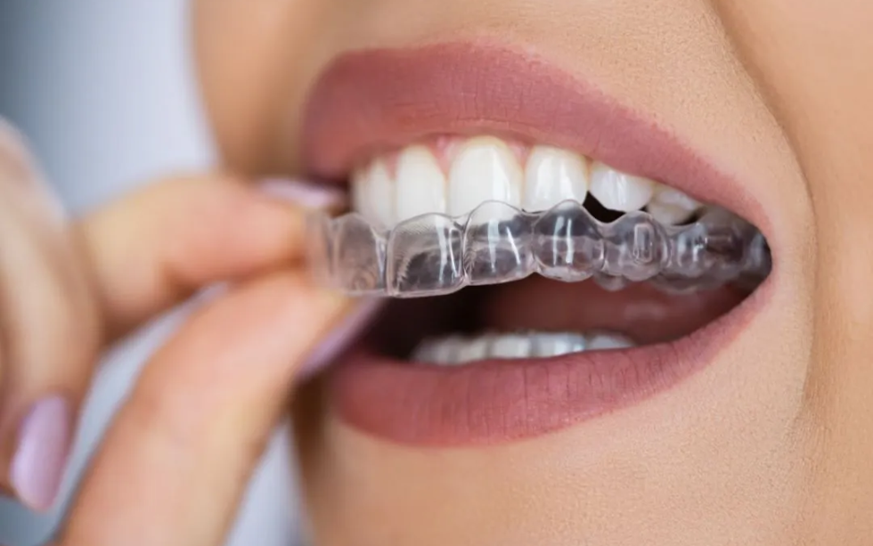 How To Straighten Teeth Without Braces – Is It Possible?