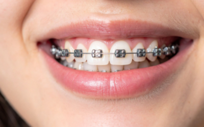 How Do Teeth Braces Work?