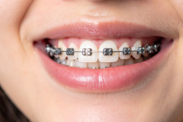 How Do Teeth Braces Work?