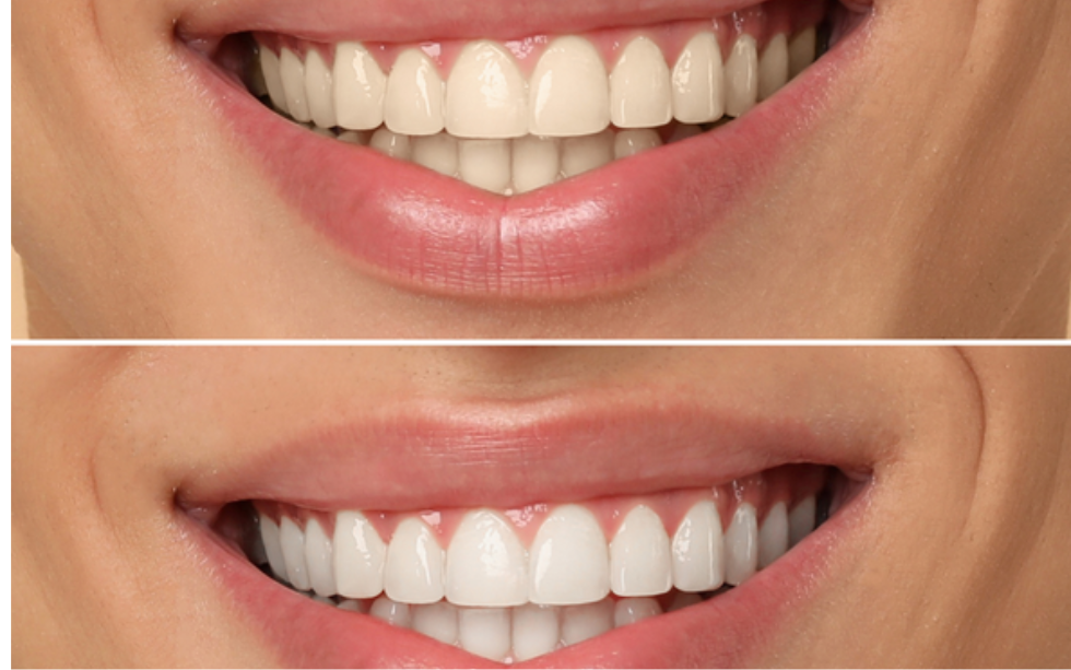 Teeth Whitening Cost In Hyderabad