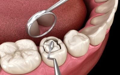 What Happens During a Dental Filling? A Step-by-Step Guide