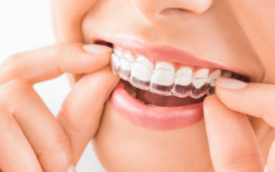 Braces and Teeth Alignment