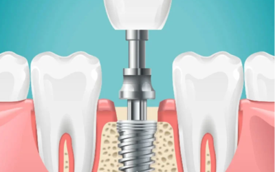 Dental Implants and Tooth Replacement