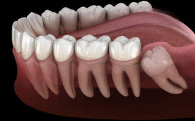 Wisdom Tooth Removal